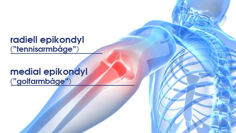 Diagram of radial epicondyle and medial epicondyle