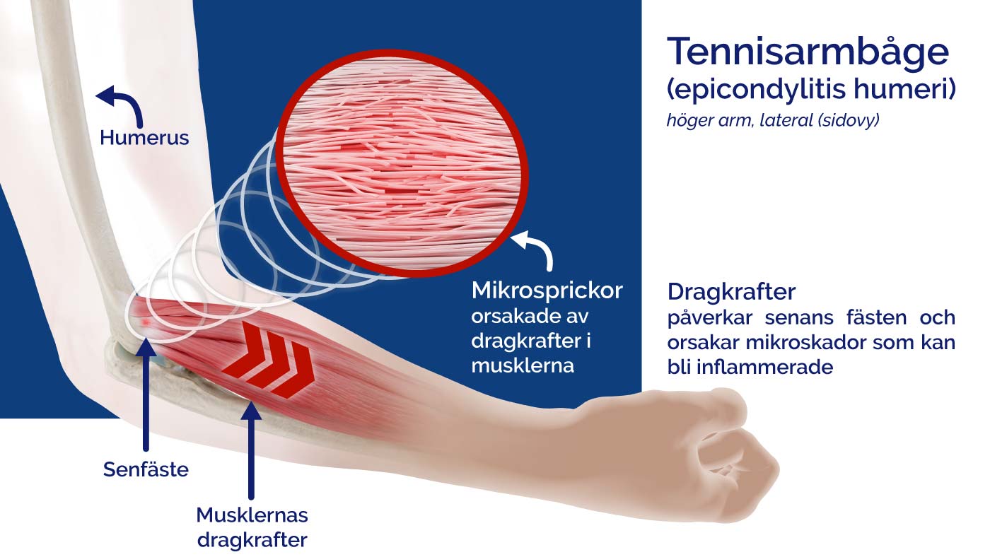 Diagram cause of epicondylitis, tennis elbow, golfer's elbow of Peak Padel Sweden AB.